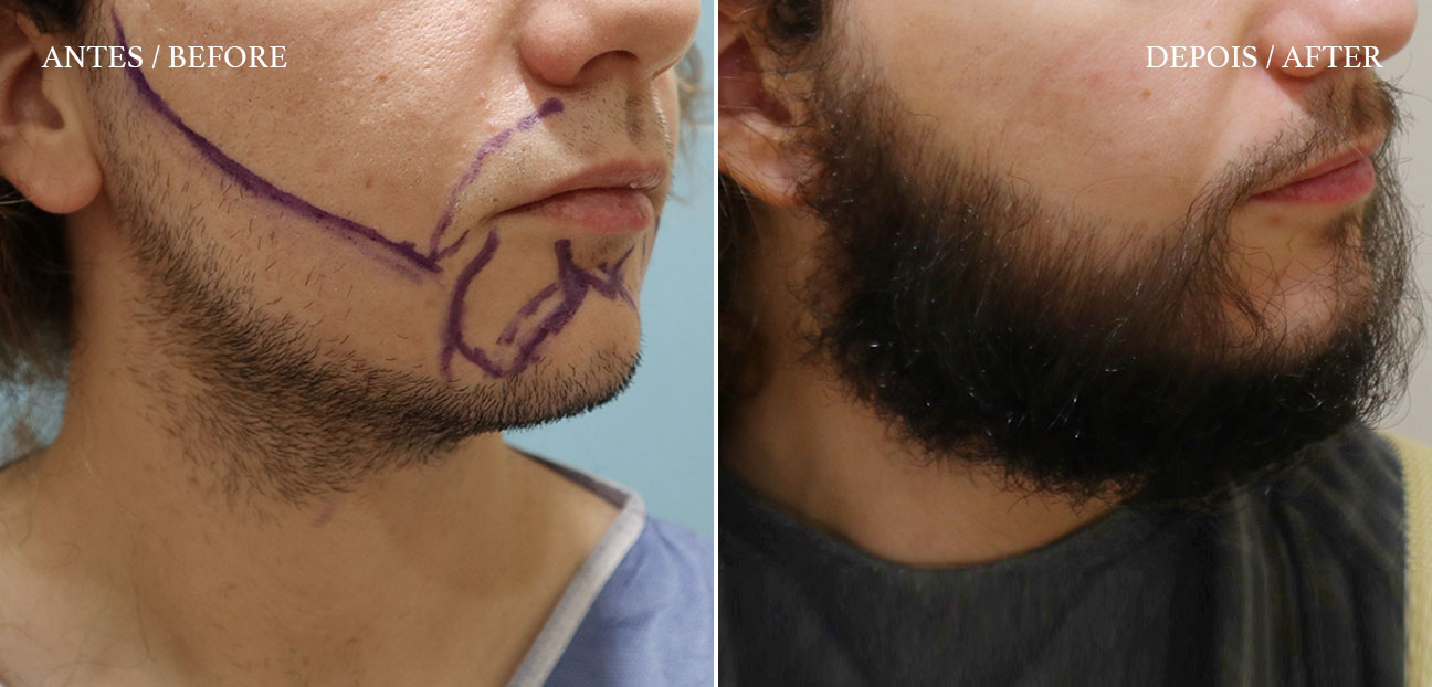 HM Clinic - imagem de um antes e depois de transplante de barba