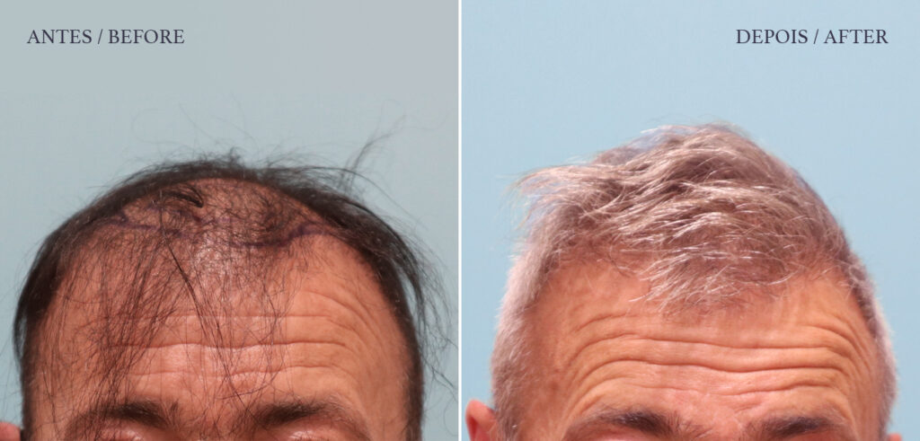 HM Clinic - Imagem de antes e depois de correção de transplante capilar prévio