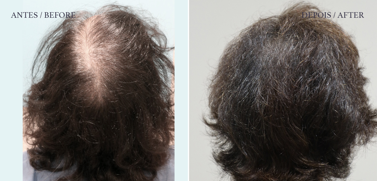 HM Clinic - imagem de um antes e depois de transplante capilar feminino - Susete vista de trás