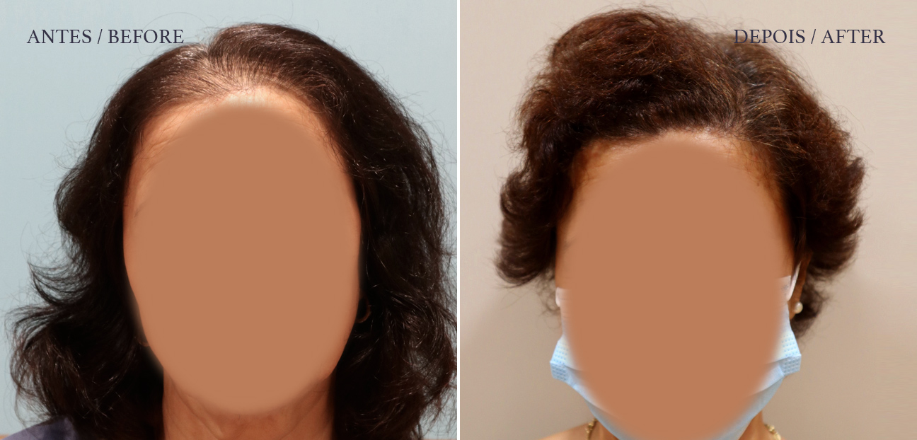 HM Clinic - imagem de um antes e depois de transplante capilar em mulher - Susete vista de frente