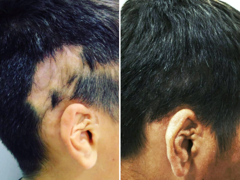 HM Clinic - Imagem de antes e depois num transplante para correção de cicatrizes