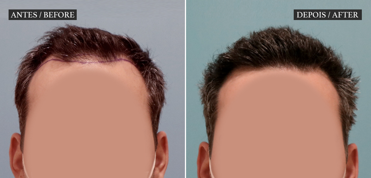HM Clinic - imagem Transplante Capilar Homem - Antes e Depois visto de frente