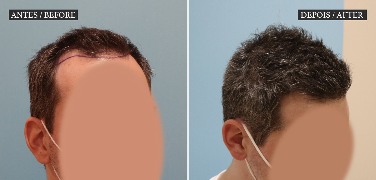 HM Clinic - imagem Transplante Capilar Homem - Antes e Depois visto a três quartos
